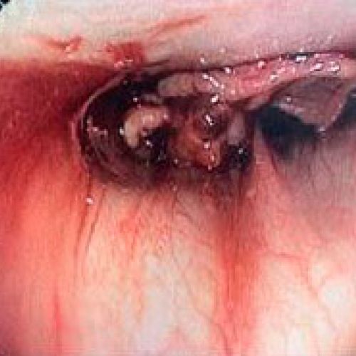 Endoscopia rígida y endoscopia flexible